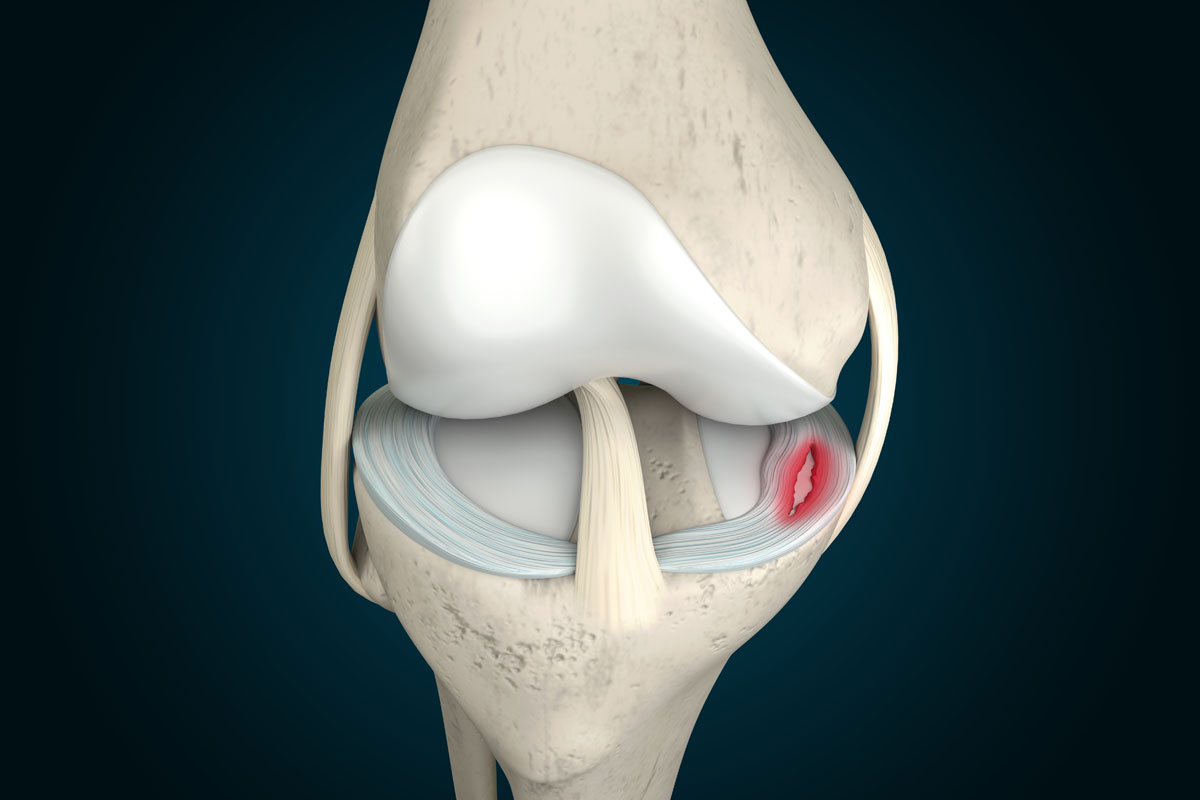 Meniscus Tear 3D